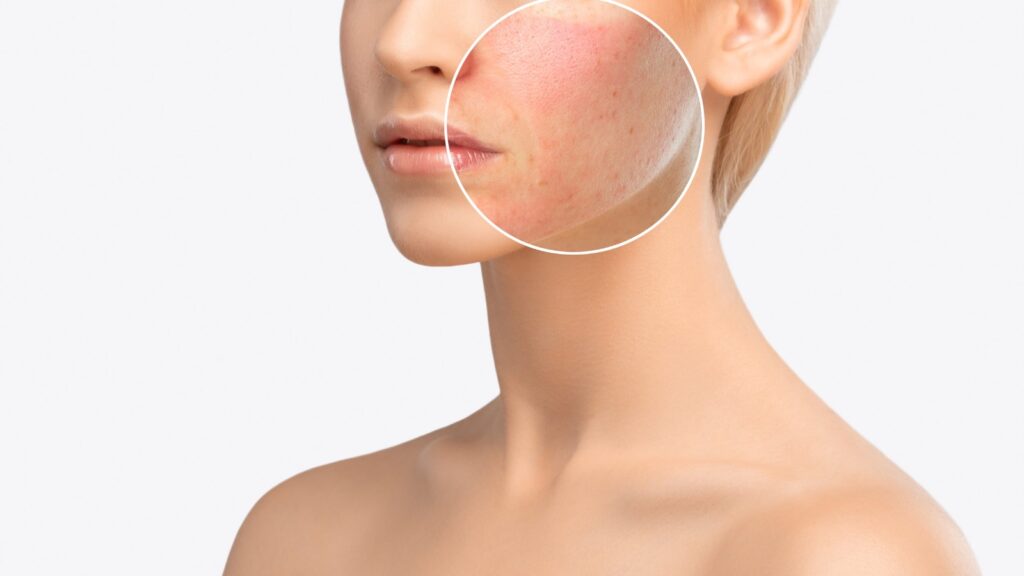 A woman's cheek and neck, with a circle marking an area of redness on the cheek